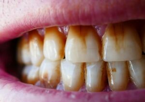 <img src="your-image.jpg" alt="Young adult with gum pain holding jaw — early signs of gum disease" title="Why Young Adults Are Facing Gum Disease Early"> 